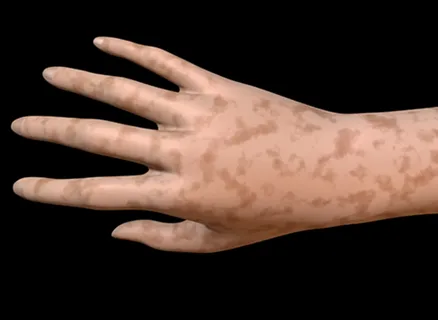 50 Things About Mottled Skin You May Not Have Known Mottled skin