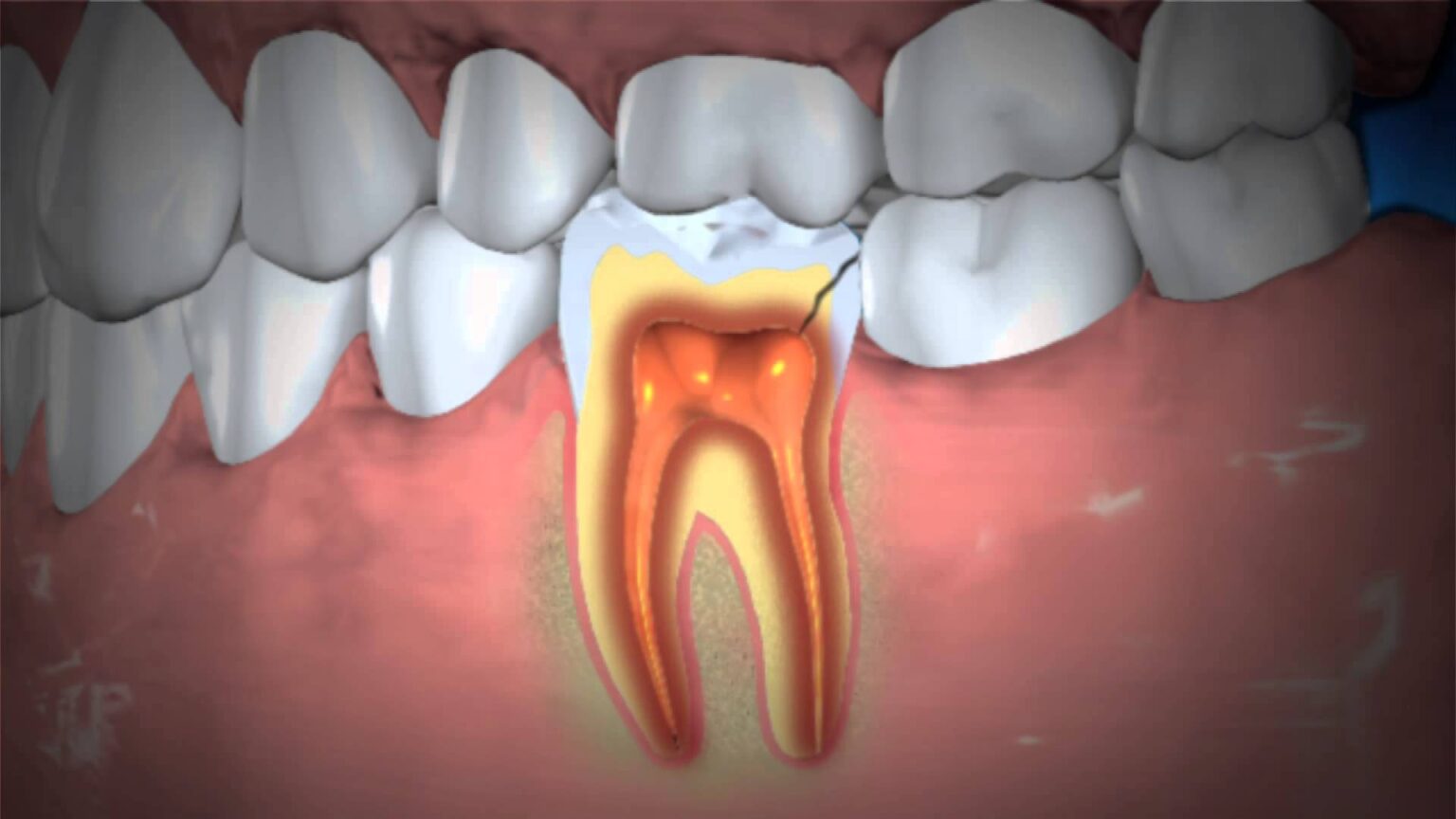 What It Means When a Tooth With Root Canal Hurts